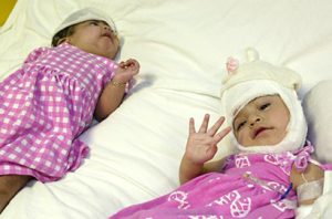 Still recovering weeks after their separation surgery, Maria de Jesús waves while sister Maria Teresa lies next to her.